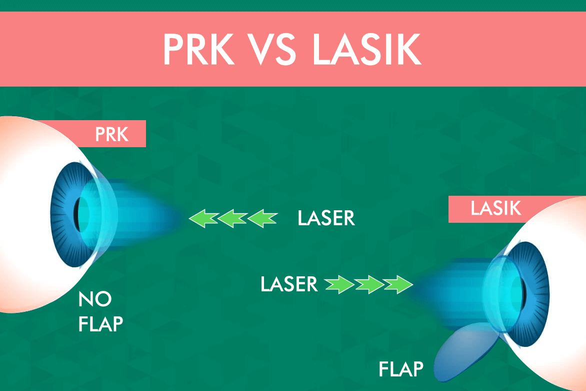 Prk Vs Lasik The Difference Between Prk And Lasik Planet Lasik