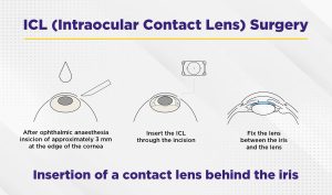 Benefits of Implantable Collamer Lens (ICL) image explaining its advantages for vision correction