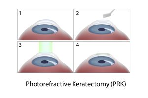 prk eye surgery procedure