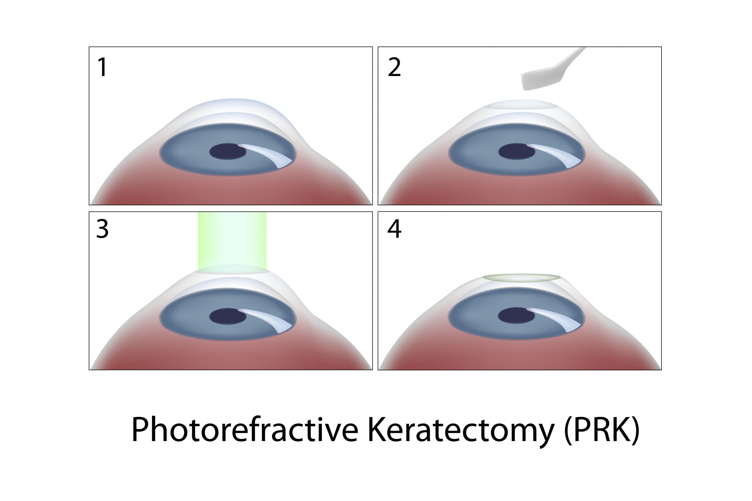 prk eye surgery procedure