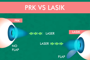 PRK vs. LASIK comparison graphic discussing differences between the two procedures