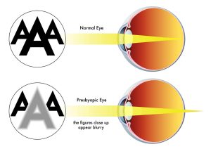 Presbyopia infographic discussing symptoms and treatment options available