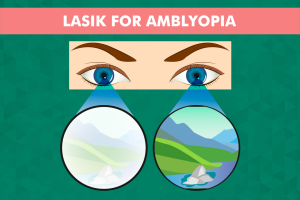 LASIK for amblyopia infographic explaining treatment options for lazy eye