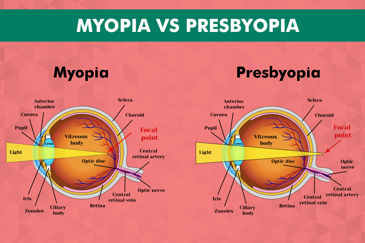 Presbyopia vs Myopia - What's The Difference? | Planet Lasik