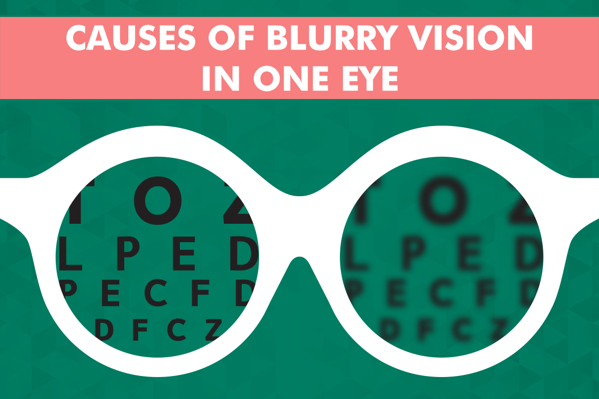 Top 13 Common Causes Of Blurry Vision In One Eye Planet Lasik 0794