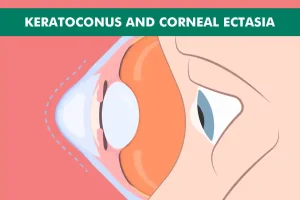 Keratoconus LASIK and Corneal Ectasia