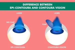 Understanding the Key Differences Between Epi-Contoura and Contoura Vision Surgery