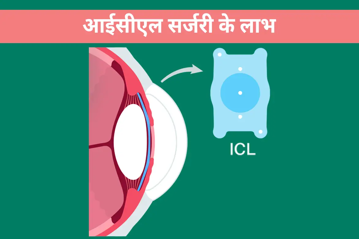 आईसीएल सर्जरी के लाभ