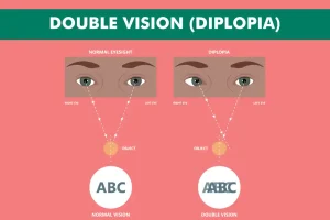 Double Vision (Diplopia) What it is, Causes & Treatment