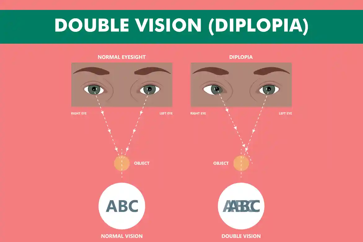 Double Vision (Diplopia) What it is, Causes & Treatment