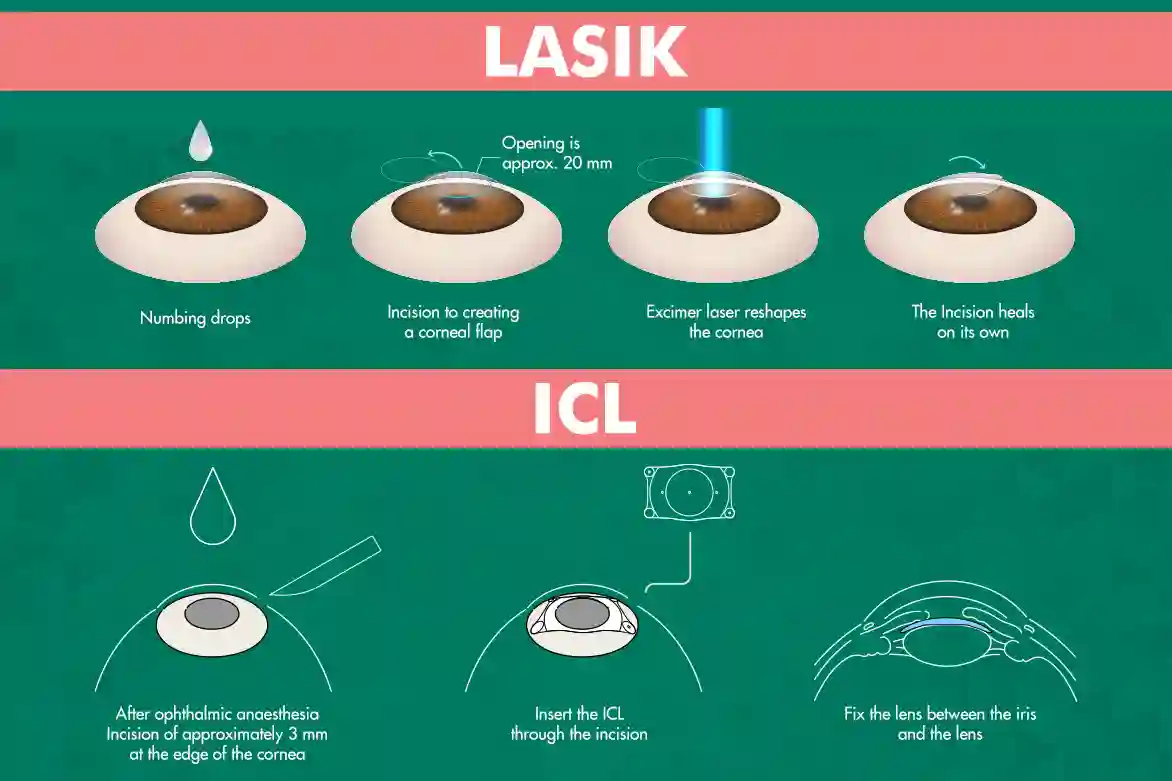 LASIK vs. ICL: Which Vision Correction Option Is Right for You?