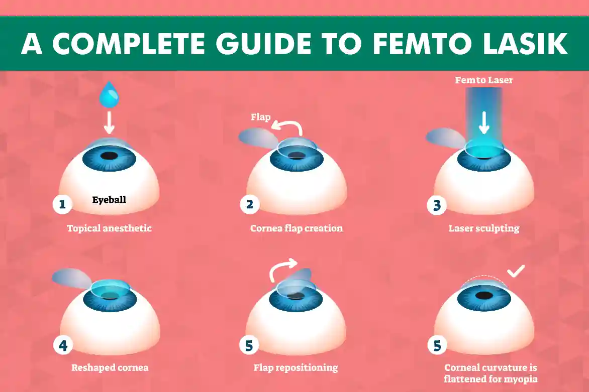 A Complete Guide to Femto LASIK: What to Expect Before, During, and After