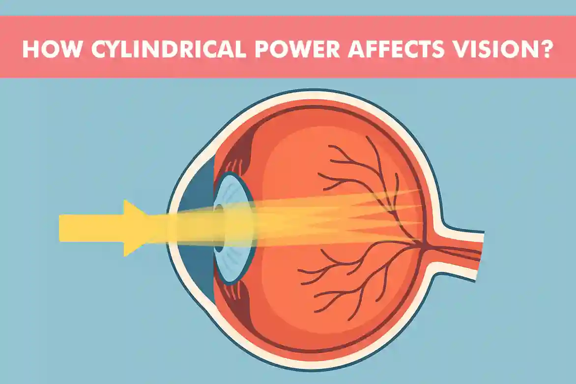How Cylindrical Power Affects Vision: Causes and Symptoms