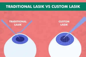 Traditional LASIK vs Custom LASIK